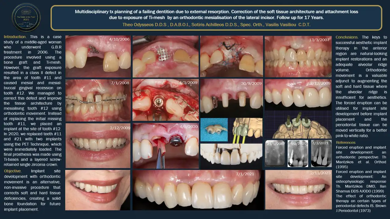 Multidisciplinary tx planning of a failing dentition due to external resorption. Correction of the soft tissue architecture and attachment loss due to exposure of Ti-mesh by an orthodontic mesialisation of the lateral incisor. Follow up for 17 Years.