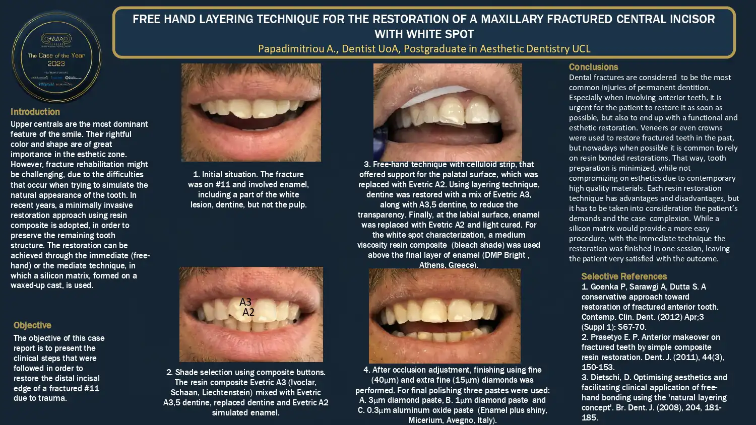 Free hand layering technique for the restoration of a maxillary fractured central incisor with white spot.