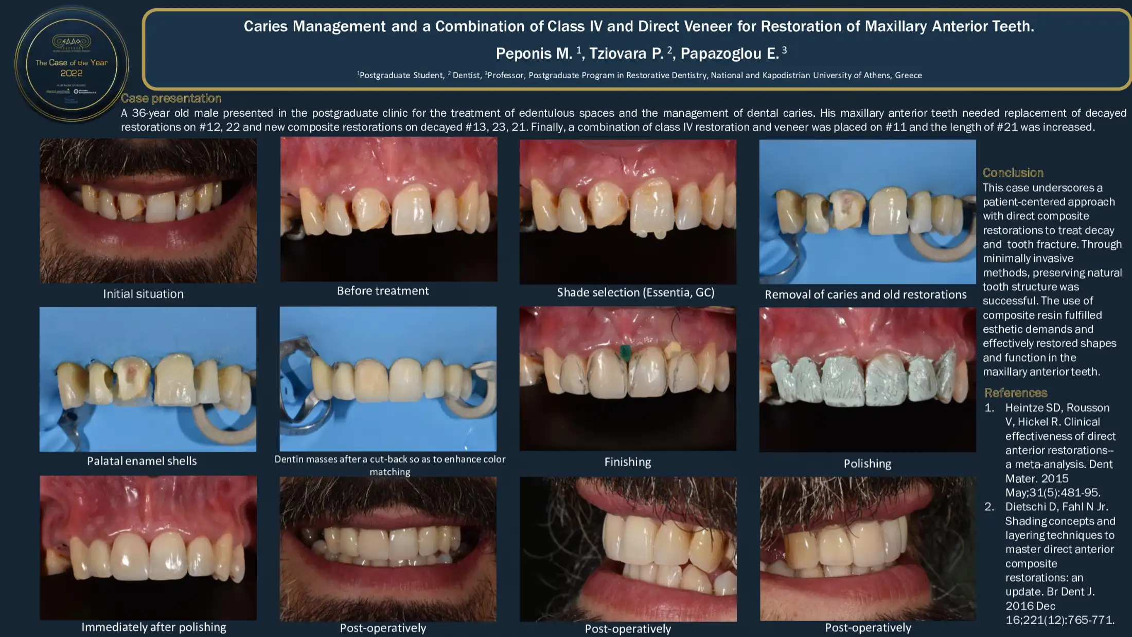 Caries Management and a Combination of Class IV and Direct Veneer for Restoration of Maxillary Anterior Teeth.