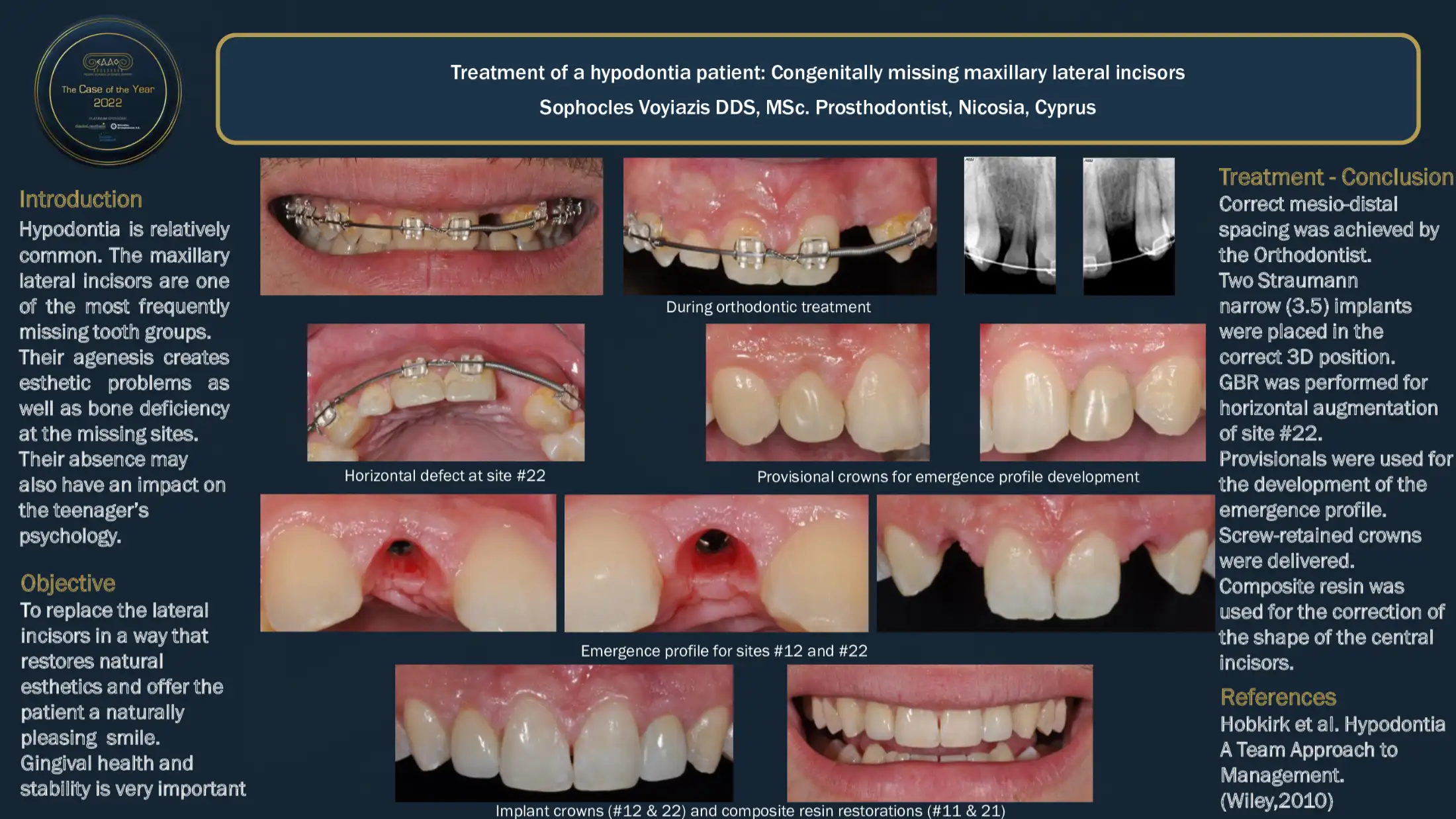Treatment of a hypodontia patient: Congenitally missing maxillary lateral incisors.