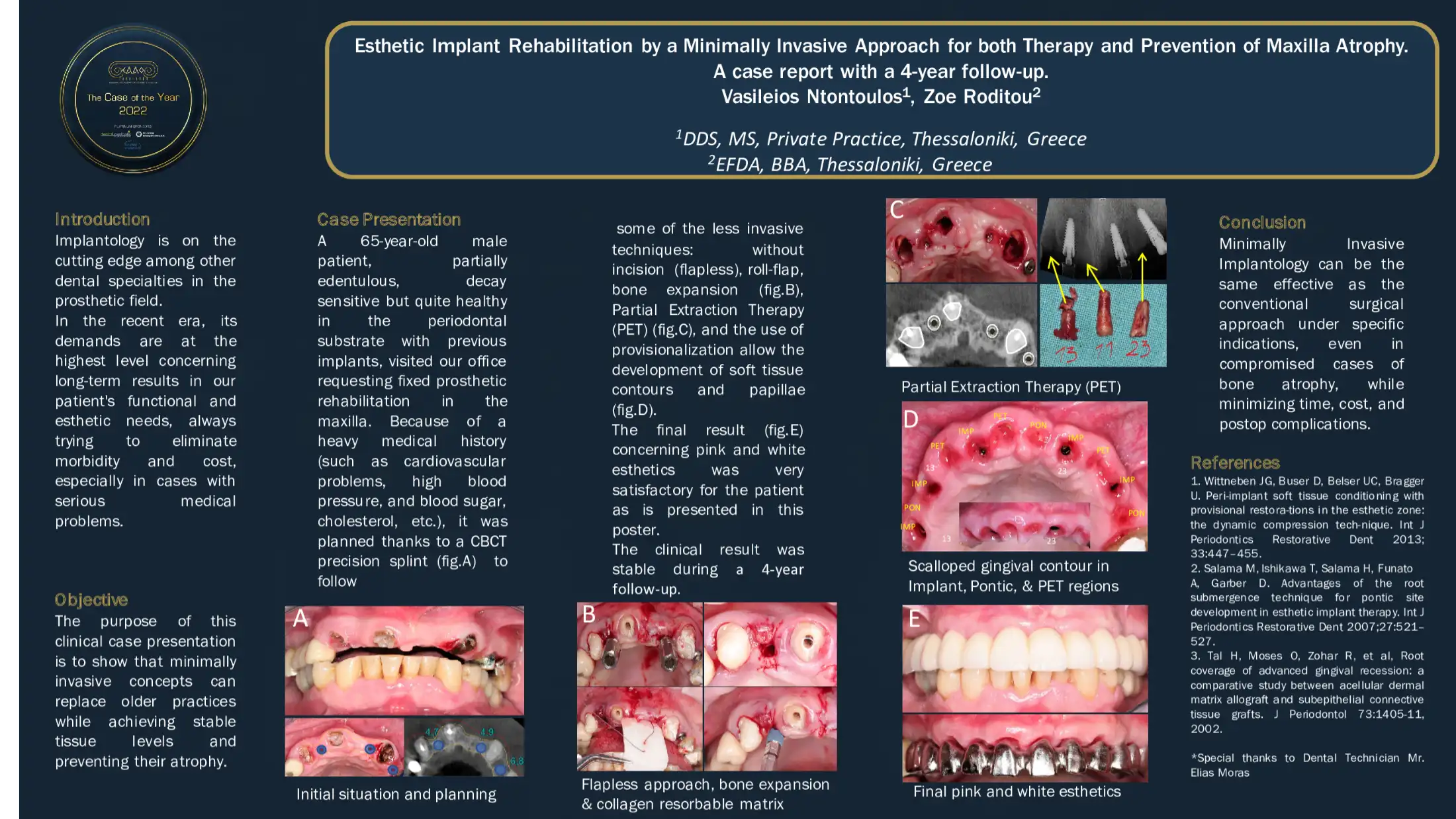 Esthetic Implant Rehabilitation by a Minimally Invasive Approach for both Therapy and Prevention of Maxilla Atrophy. A case report with a 4-year follow-up.